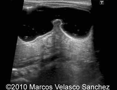 Duodenal_atresia_Marcos_4