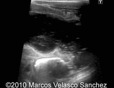 Duodenal_atresia_Marcos_5