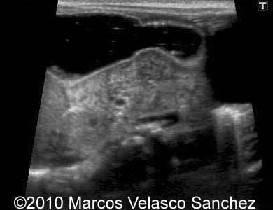 Duodenal_atresia_Marcos_6