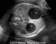 Duodenal atresia image