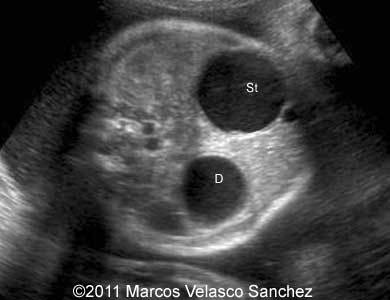 Duodenal_atresia_Sanchez_1