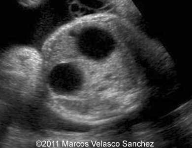 Duodenal_atresia_Sanchez_2