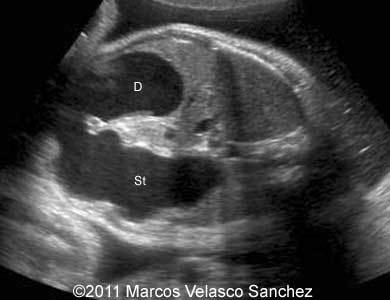 Duodenal_atresia_Sanchez_3