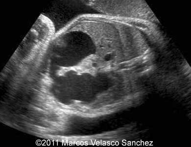 Duodenal_atresia_Sanchez_4