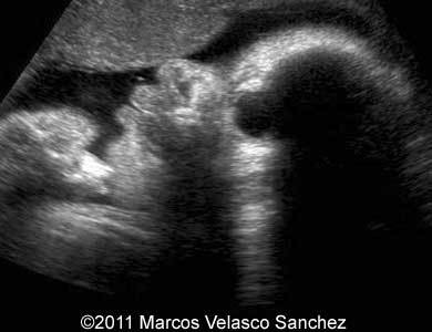 Duodenal_atresia_Sanchez_5