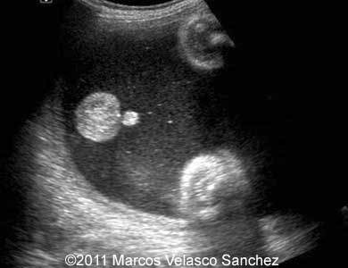 Duodenal_atresia_Sanchez_6