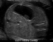 Duodenal stenosis image