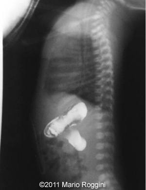 Duodenal_stenosis_10