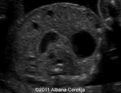 Duodenal_stenosis_2