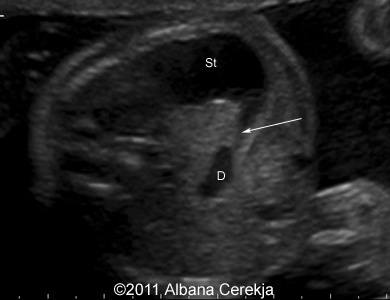 Duodenal_stenosis_3a