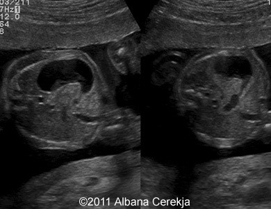 Duodenal_stenosis_8