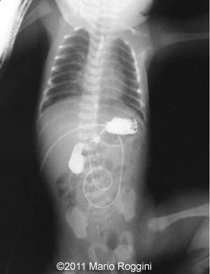 Duodenal_stenosis_9