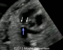 Early pulmonary valve anomalies image