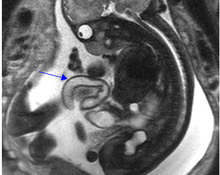 MRI, Omphalocele, gastroschisis and Pentalogy of Cantrell image