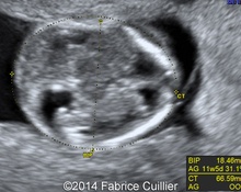Trisomy 18, 12 weeks image
