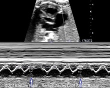 Premature atrial contractions with transient atrial quadrigeminy image