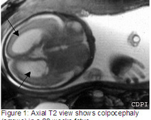 Agenesis of the corpus callosum image