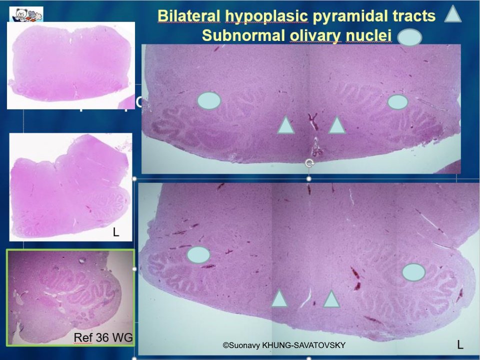 In comparison to the reference picture at 36 weeks gestation on the lower left corner, these images show bilateral hypoplastic pyramidal tracts, with preserved olivary nuclei.