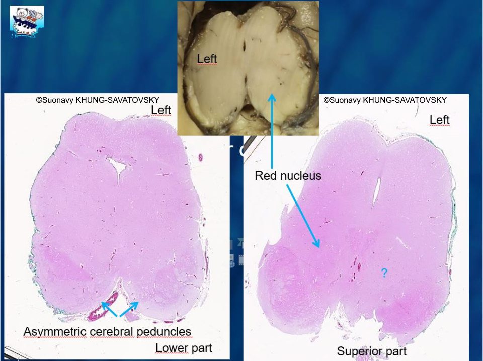Asymmetric cerebral peduncles. Absence of red nucleus on the left side (?) compared to the right side.