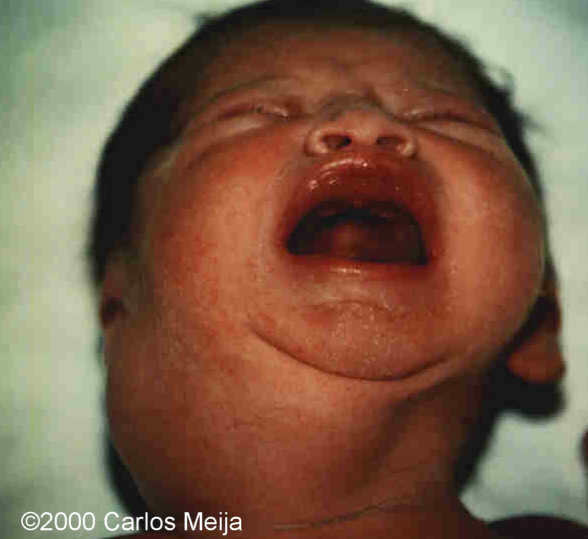 hemangiolinfangioma 6-birth