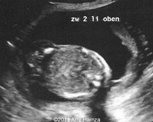 Heterotopic pregnancy image