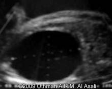 Persistent urogenital sinus with hydrometrocolpos image