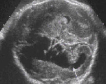 Aplasia cutis congenita image