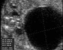 Posterior urethral valves, 15 weeks image