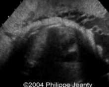 Achondroplasia, video clip image