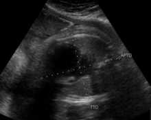 Complete auriculoventricular canal, dextrocardia and absent interventricular septum image