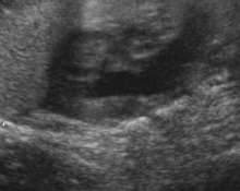 Hypoplastic left heart syndrome, 40 weeks image