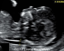 Trisomy 18, first trimester image