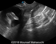 IUD with intrauterine pregnancy image