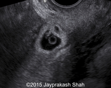 LSCS scar ectopic pregnancy - Novel management experience image