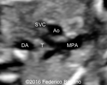 Right aortic arch image