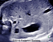 Spleen cyst image