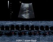 Concomitant PACs and PVCs with umbilical vein varix image