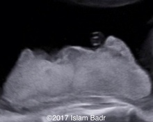 Circumvallate placenta image