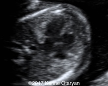 Double outlet right ventricle with non-committed VSD image