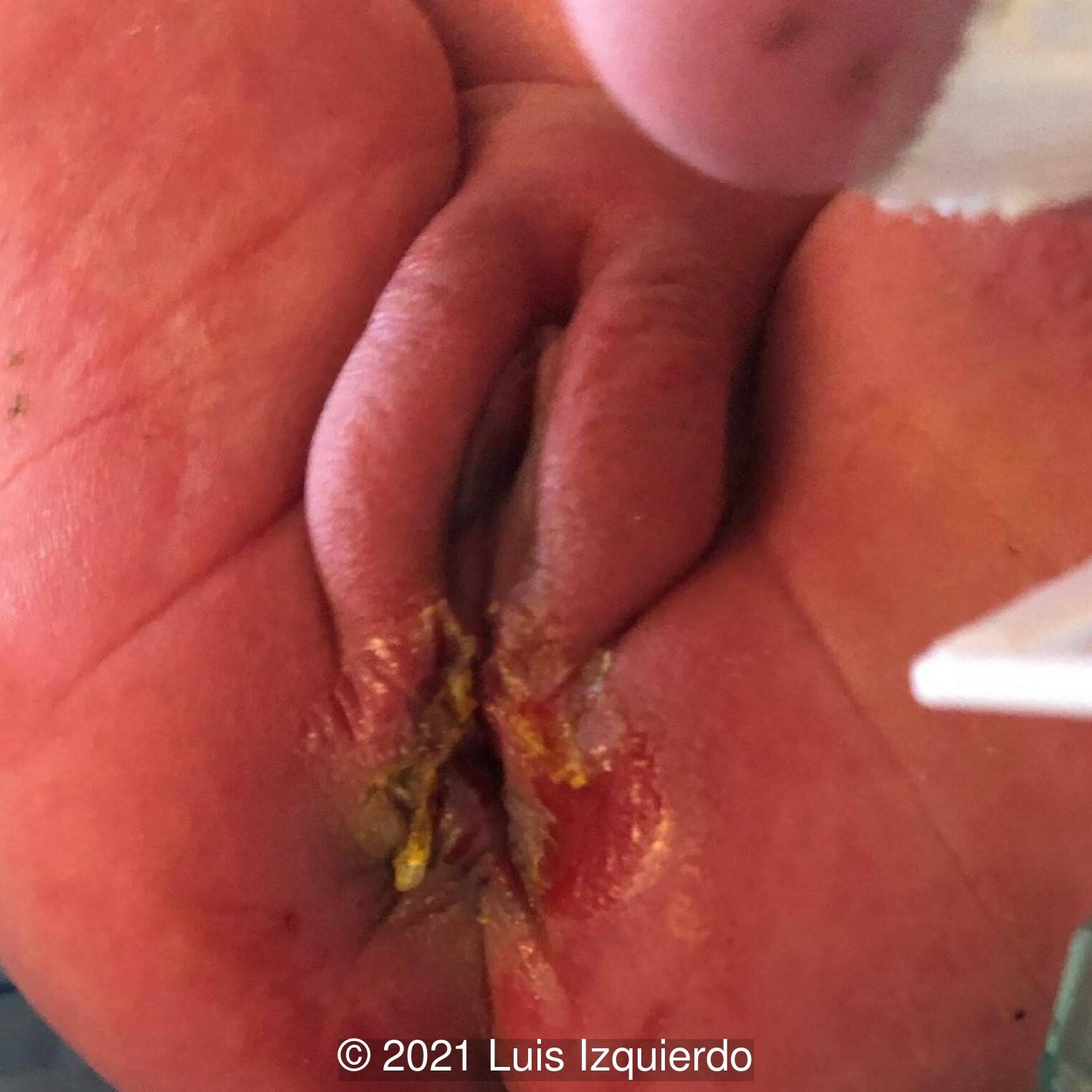 Post-operative image after resection of the perineal mass. Note the normal femal genitalia.
