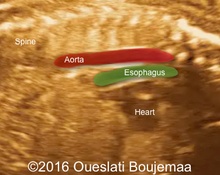 Normal fetal esophagus image