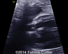 Absent pulmonary valve syndrome, 40 weeks image