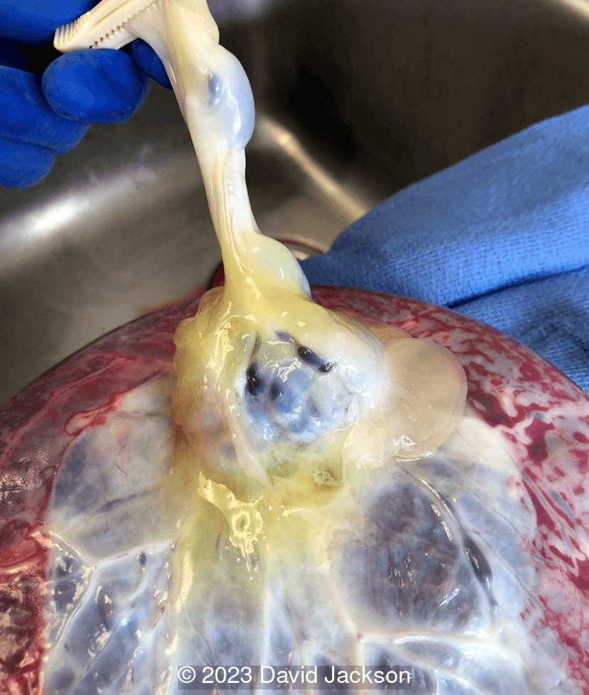 Cord insertion with pseudocyst and tumor with firm, rubber consistency at the base.