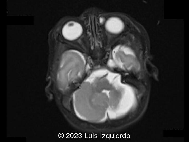 Postnatal brain MRI shows abnormal appearance of the posterior cranial fossa and left cerebellar hemisphere hypoplasia. Vermis appears present though mildly hypoplastic and malrotated.