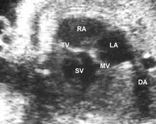 Double inlet single ventricle image