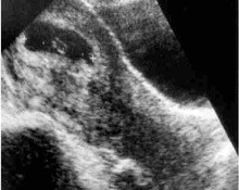 Heterotopic pregnancy image