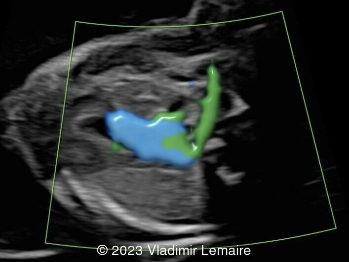 Aberrant right subclavian artery, seen in green, in the same fetus.