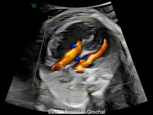 Color flow mapping demonstrating blood flow entering the ventricles in diastole