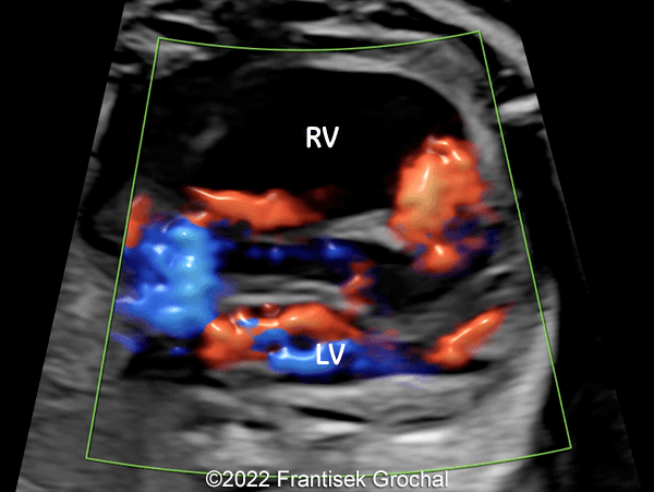 Four-chamber view of the heart (RV-right ventricle; LV-left ventricle)