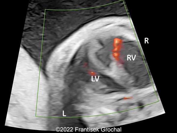 Four-chamber view of the heart (RV-right ventricle; LV-left ventricle; R-right; L-left)